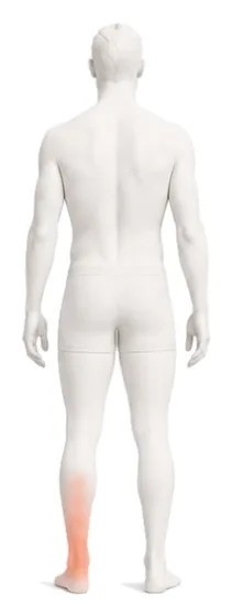 Body illustration with the Achilles tendon and the back of the heel highlighted.